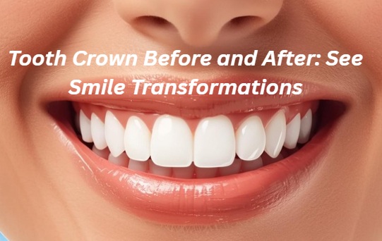 Tooth Crown Before and After: See Smile Transformations